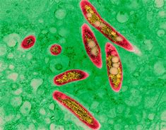 Image result for Mycobacterium Avium Infection