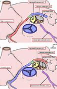 Image result for Left Ventricular Outflow Tract Stroke Volume