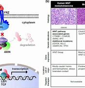 Image result for Shh Pathway Medulloblastoma