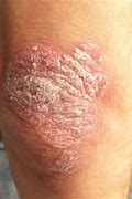 Image result for Scaly Rash