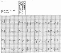 Image result for Bigeminal Rhythm