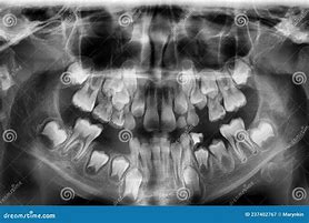 Image result for Thumb X-ray Child