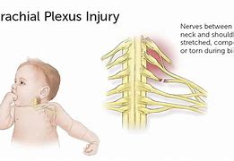 Image result for Brachial Plexus Injury