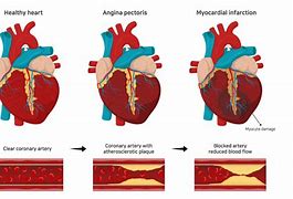 Image result for High Blood Pressure and Heart Disease