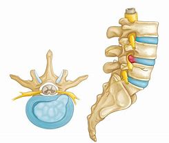 Image result for Lumbar Spine Herniation