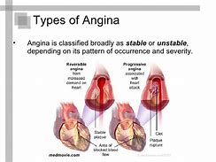 Image result for Angina Pectoris Anatomical Position