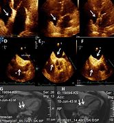 Image result for Interatrial Septum Lipomatous Hypertrophy Echo