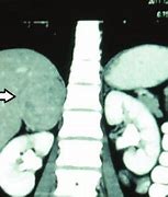 Image result for Pheochromocytoma On CT Scan