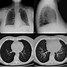 Image result for Chest X-ray of TB