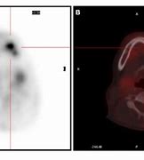 Image result for Pet Scan Glucose