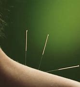 Image result for Acupuncture