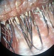 Image result for Eyelash Mites Symptoms