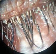 Image result for Human Eyelash Mites