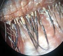 Image result for Treatment for Eyelash Mites