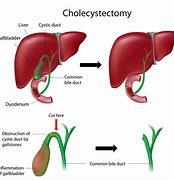 Image result for Cholecystectomy Ultrasound