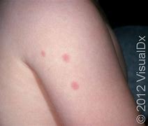 Image result for Baby Bed Bug Bites