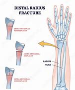 Image result for Radius Fracture