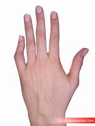 Image result for Dislocated Finger Joint