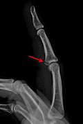 Image result for Volar Fracture