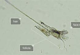 Image result for Mites Under Skin