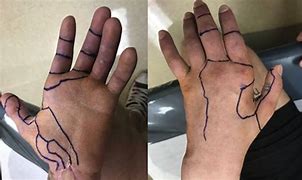 Image result for Volar and Dorsal Hand