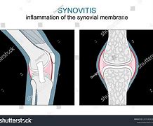 Image result for Inflammed Synovial Tissue