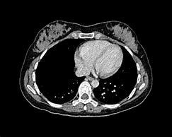 Image result for Lung Cancer On CT