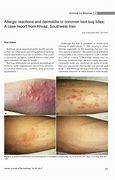 Image result for Benedryl Bug Bites