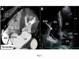 Image result for Septal Aneurysm