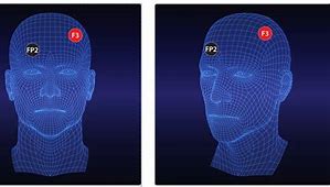 Image result for What Is a tDCS