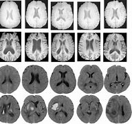 Image result for Abnormal MRI Scans