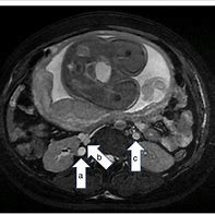 Image result for Retrocaval Ureter MRI