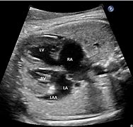 Image result for Right Atrial Appendage Fetal Echo