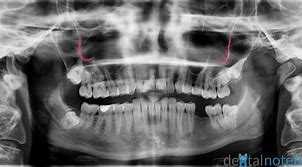 Image result for Zygomatic Smile