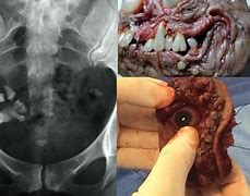 Image result for Teratoma Baby Boy