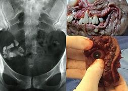 Image result for Teratoma