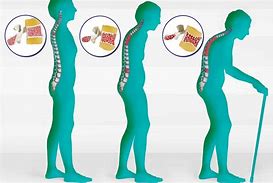 Image result for Osteoporosis Lumbar Spine