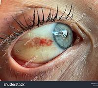 Image result for Orbital Hemorrhage CT