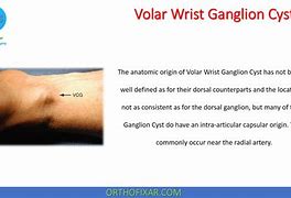 Image result for Volar Wrist Cyst