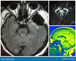 Image result for Aneurysm in MRI