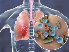 Image result for Pathogens Causing Pneumonia