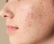 Image result for Acne Scars Home Remedy