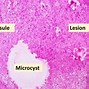 Image result for Vestibular Schwannoma Gross Pathology