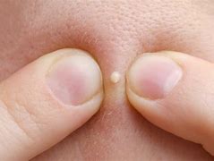 Image result for Pop Pimple Popping