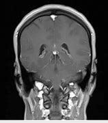 Image result for Abnormal Brain MRI without Contrast