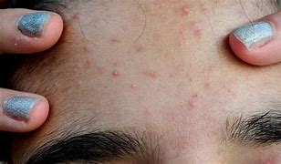 Image result for Itchy Face with Pimples