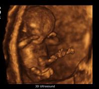 Image result for 13 Week Baby Ultrasound