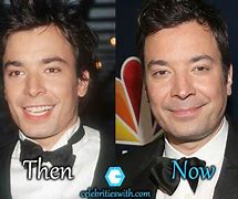 Image result for Jimmy Fallon Plastic Surgery