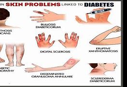 Image result for Diabetes Skin Darkening