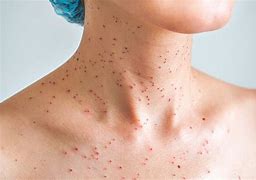 Image result for Dark Red Spots On Skin